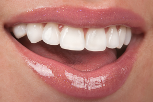 porcelain veneers
